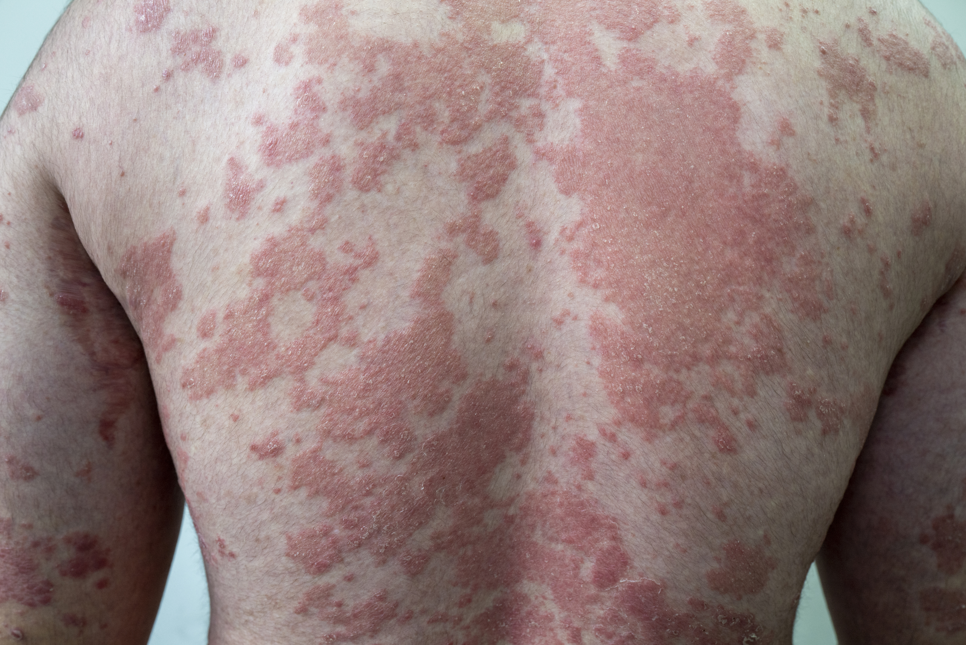 psoriasis on back