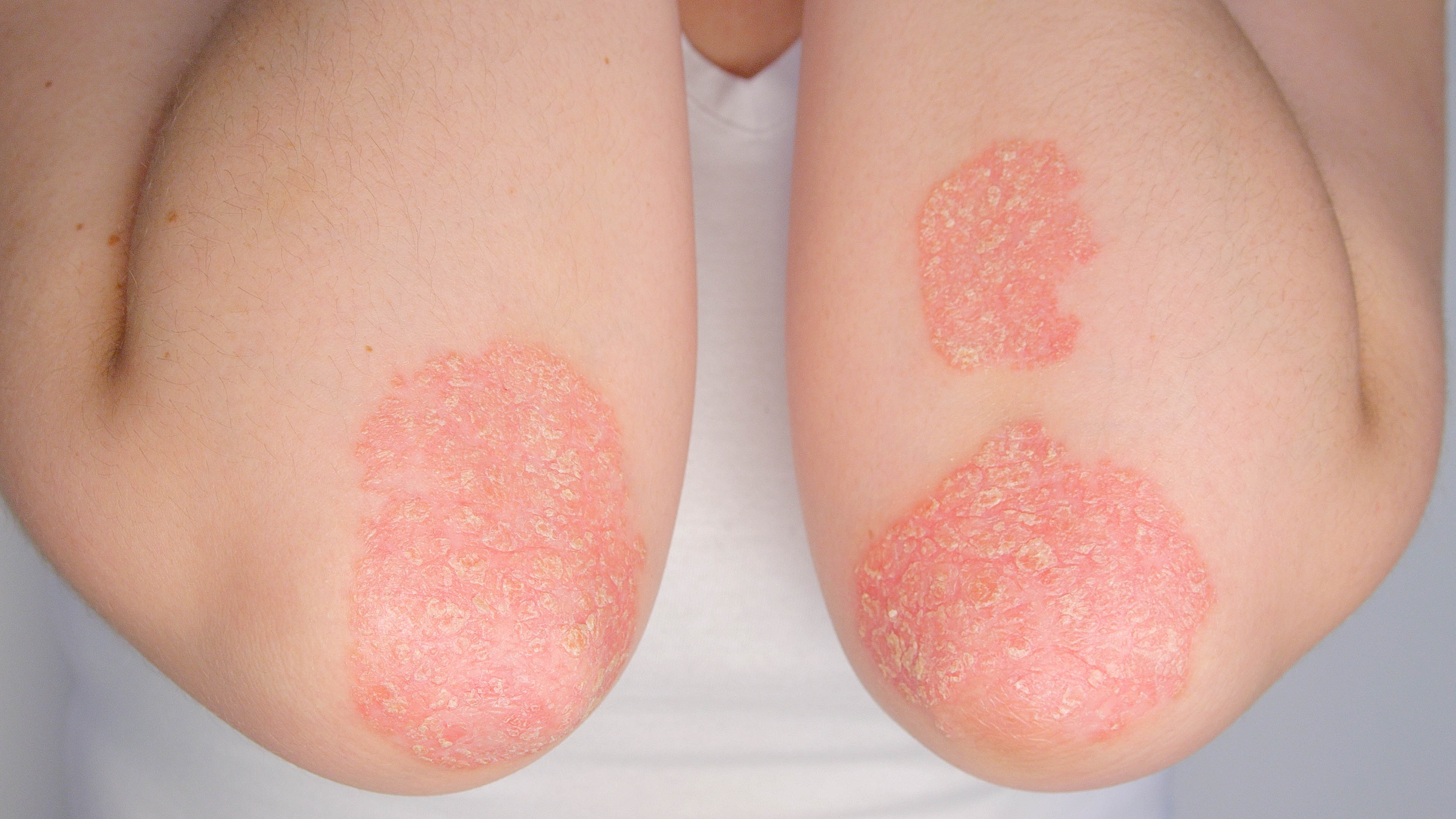 psoriasis on elbows