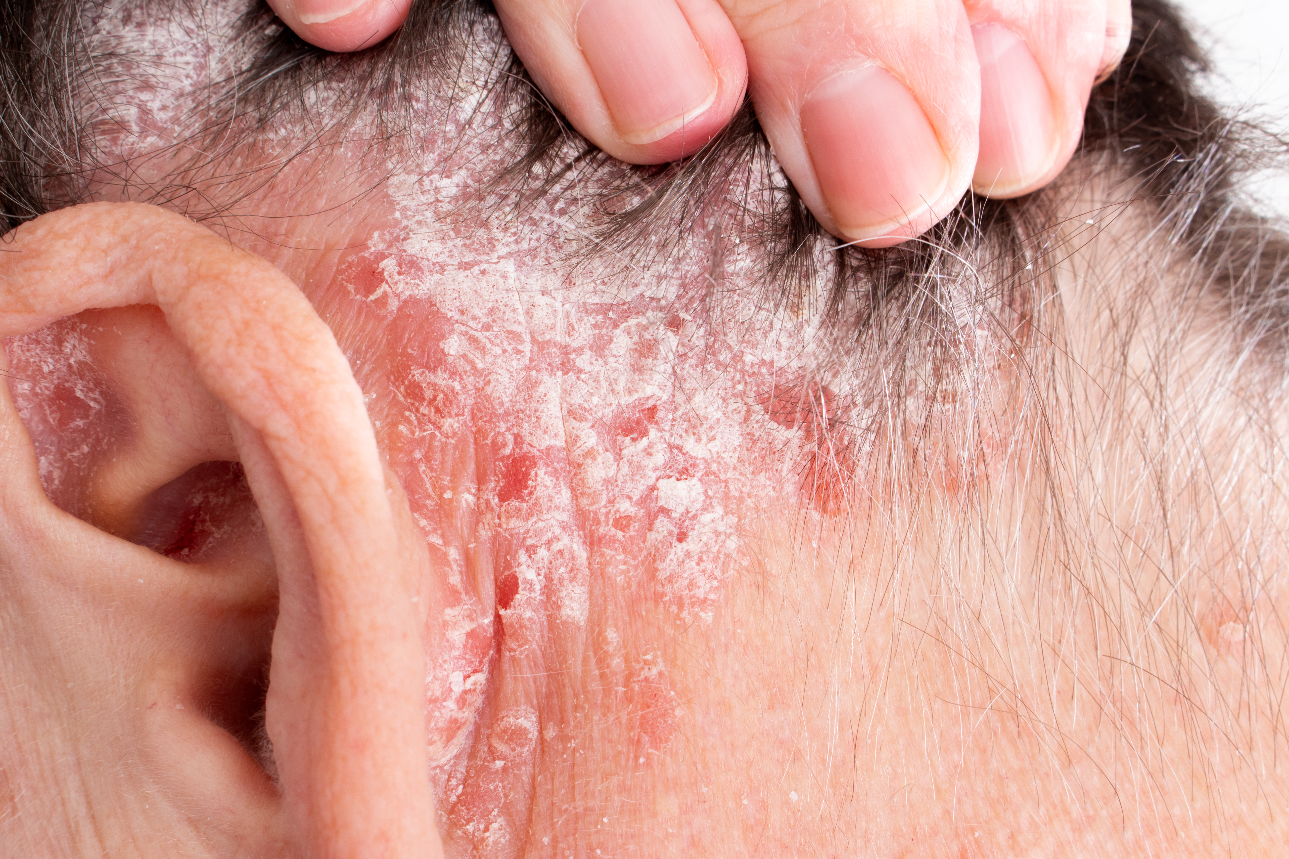 psoriasis on hair