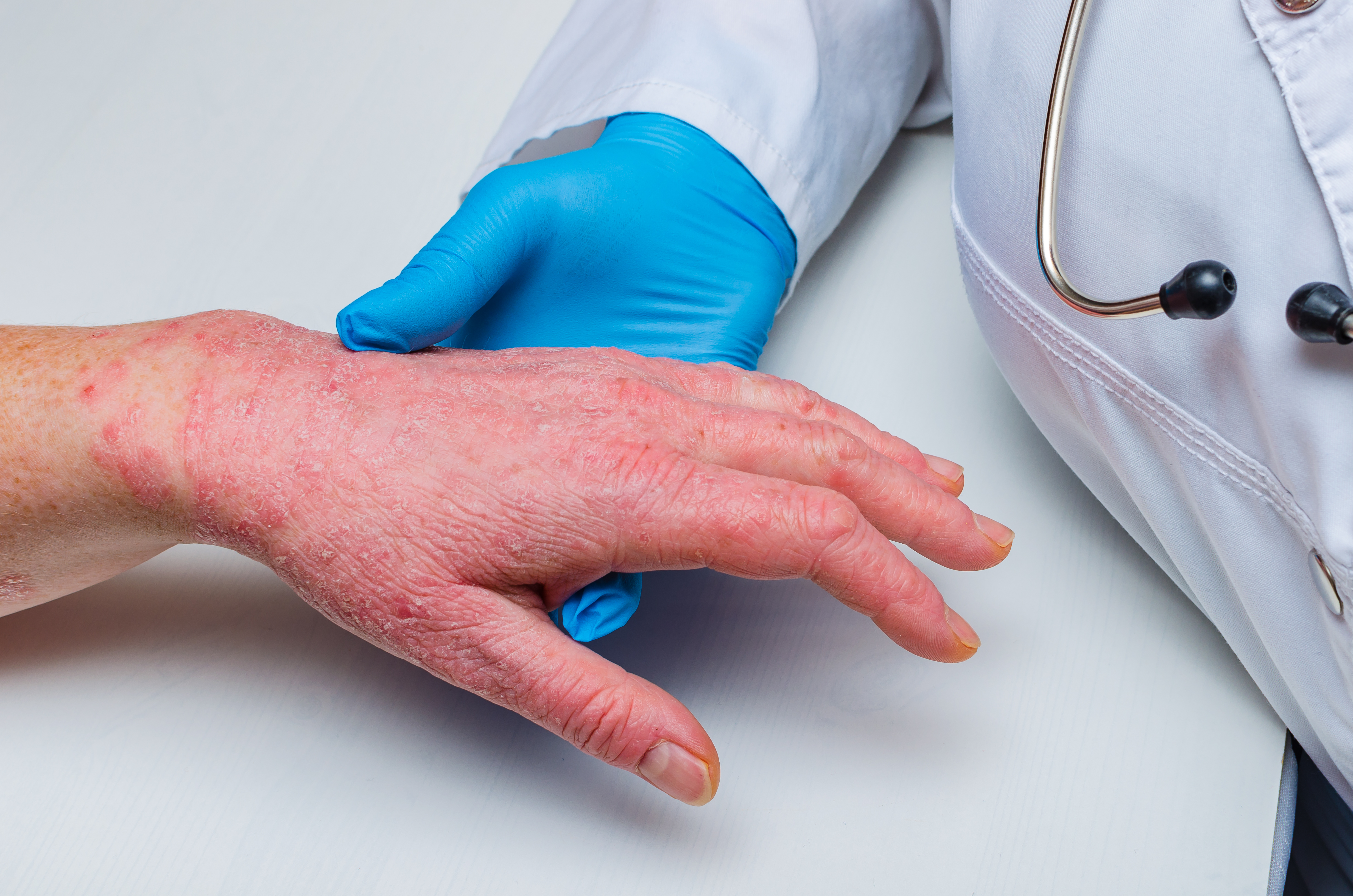 psoriasis on hand