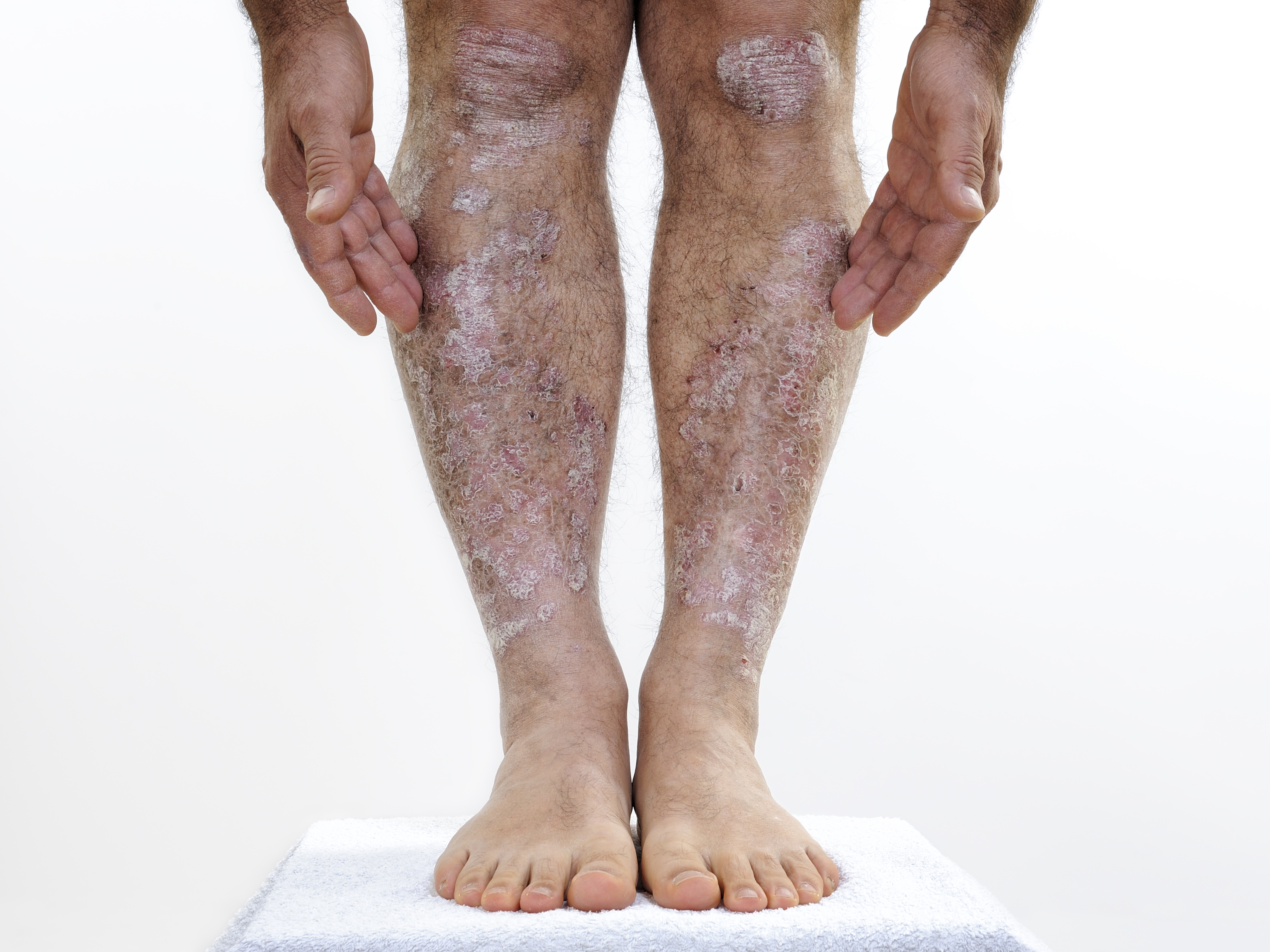 psoriasis on legs